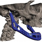 3D Printed Bones 2
